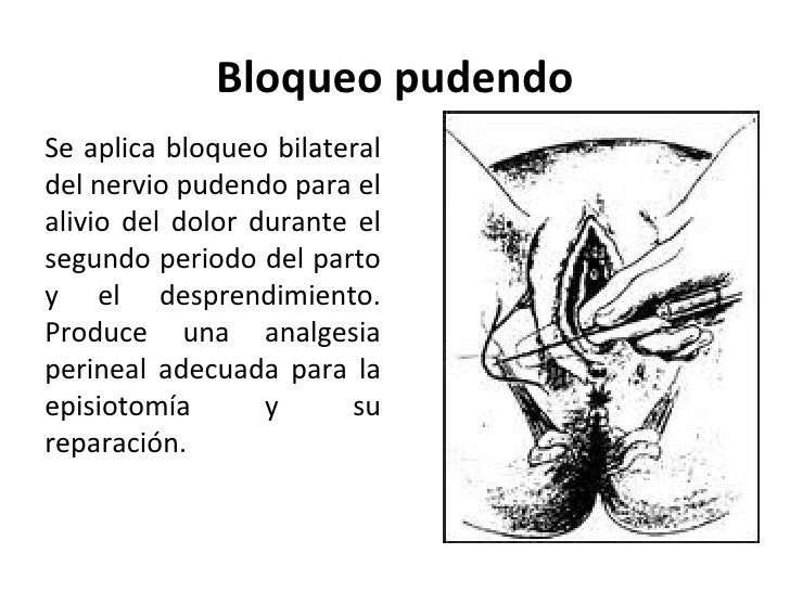 bloqueo del nervio pudendo